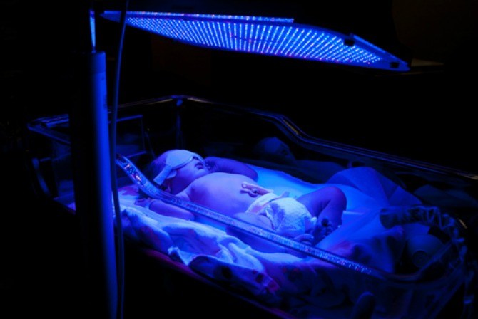 newborn jaundice and breastfeeding