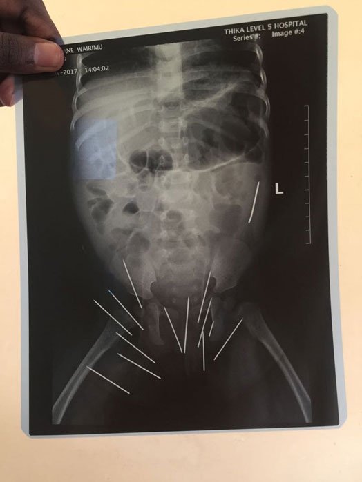 An x-ray showing 14 needles mysteriously lodged in a baby's buttocks. Doctors at the Thika Level Five Hospital have so far removed 13 needles. PHOTO | MARY WAMBUI