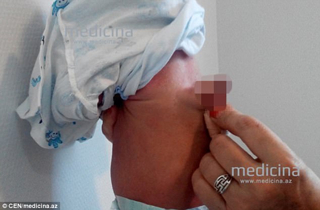 A baby boy born with an extra penis on his back has had the organ removed