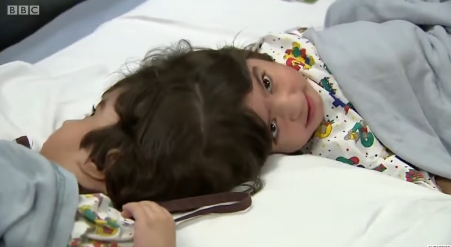 Conjoined Twins Finally Home After Successful Operation