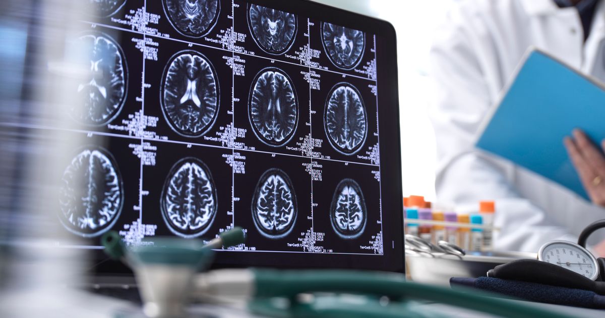 There's A Promising New Alzheimer's Drug. Here's Who Can Take It.