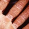 Understanding the Differences: Is Atopic Dermatitis Just Another Name for Eczema? A Comprehensive Guide