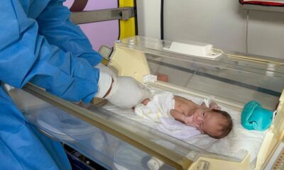 Twin Born Paper White While Other Baby Had Excess Red Blood Cells Due to Twin-to-Twin Transfusion Syndrome