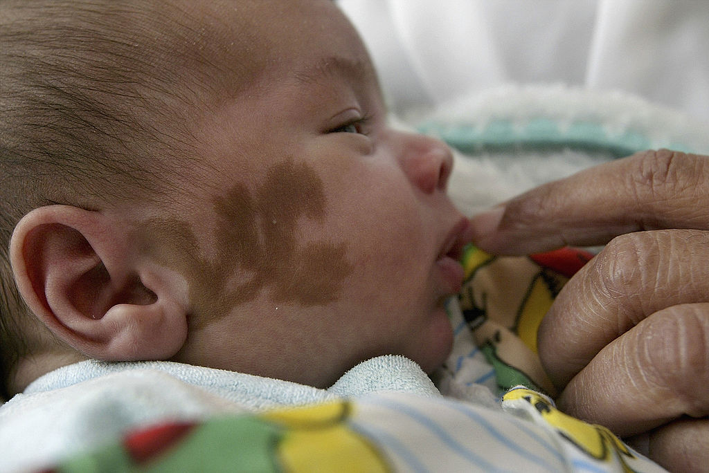 Mother Detained Overnight After Doctors Mistake Baby's Birthmarks for Bruises, Sparking Abuse Allegations