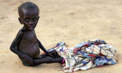 2 Million Children May Die of Malnutrition, Starvation Due to Shortage in Therapeutic Food Used To Treat Condition