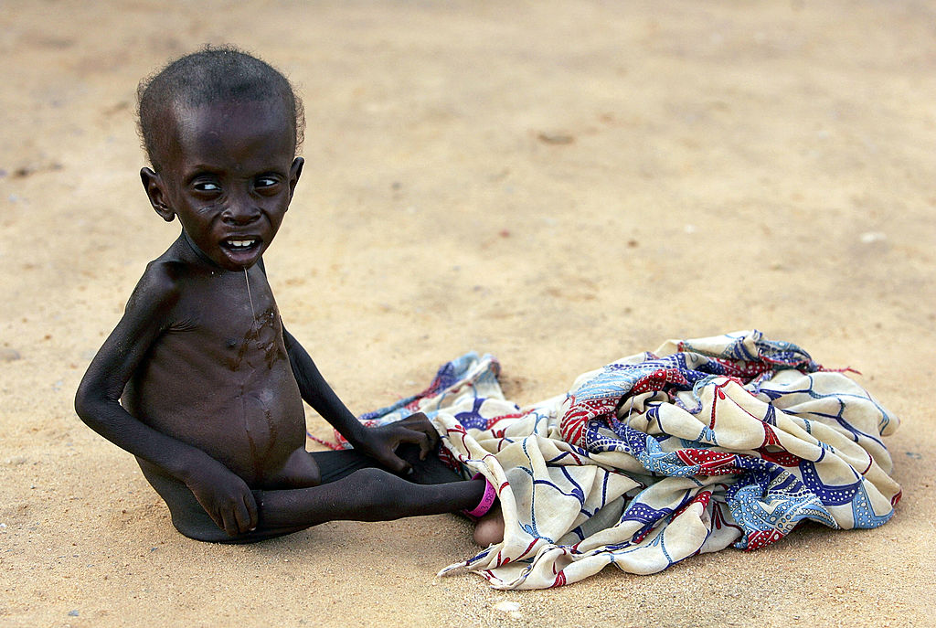 2 Million Children May Die of Malnutrition, Starvation Due to Shortage in Therapeutic Food Used To Treat Condition